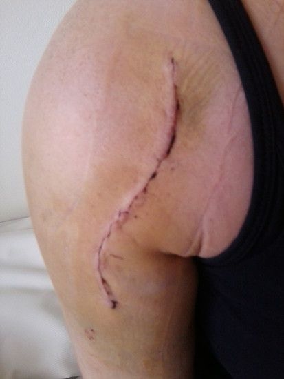 Schulter ohne Verband