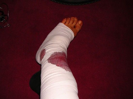 Bruch Offen Gips