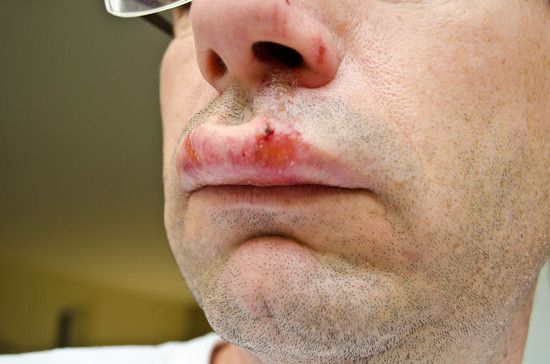 Lippe