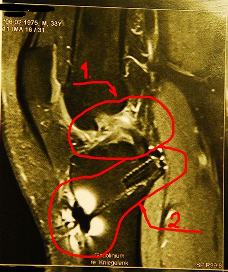 Knie aktuell Verwachsung