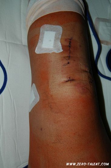 Knie