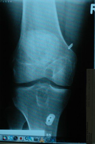 lochfraß x-ray