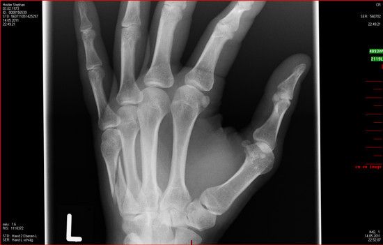 Hand 1