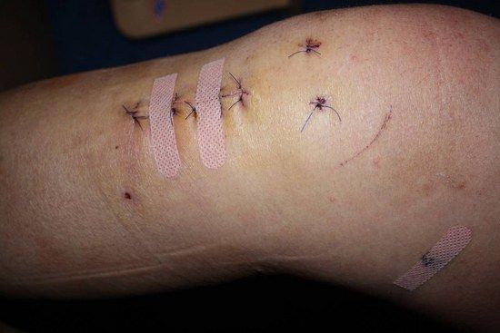 Knie fäden ziehen Ambulante Knieoperation