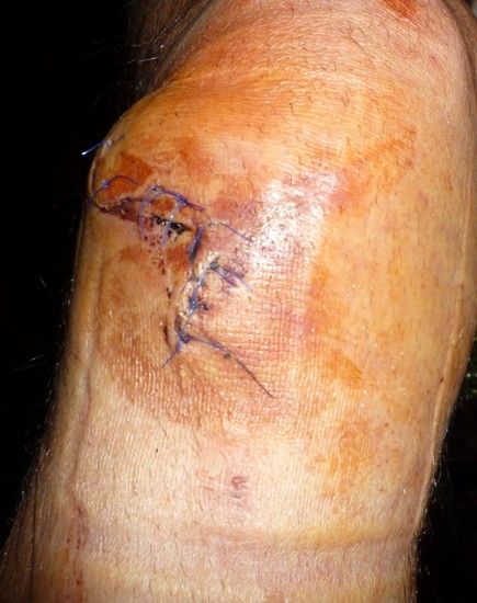 knie 1