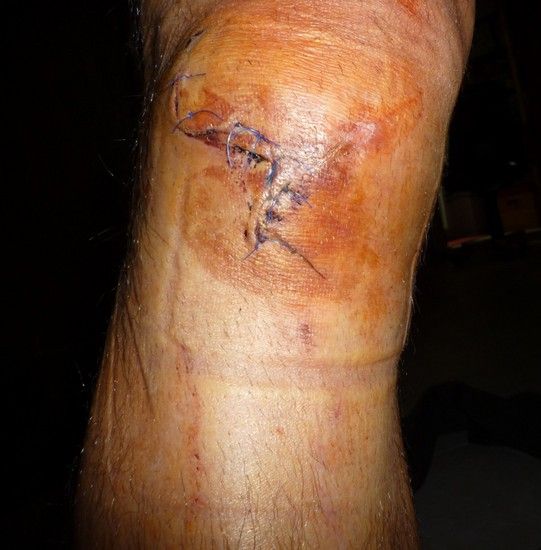 knie 2